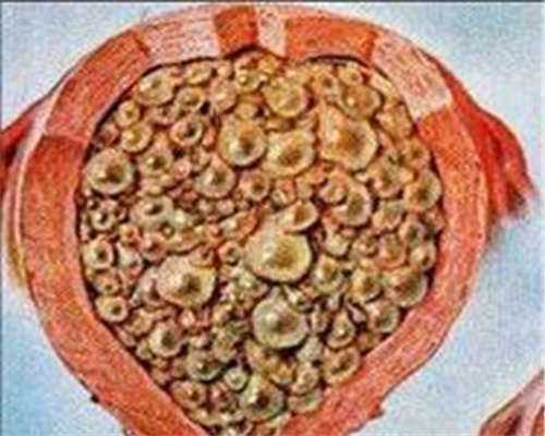 借卵自怀条件：女性多囊卵巢综合症怎么办